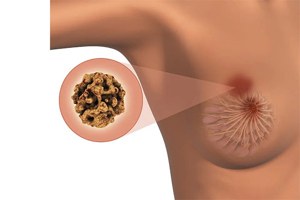 乳腺纖維瘤術后護理