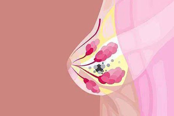 乳腺增生自我判斷