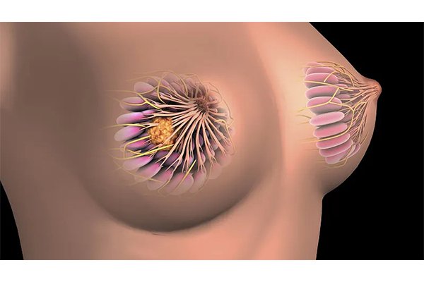 乳腺增生ai變