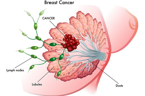 乳腺增生癥狀
