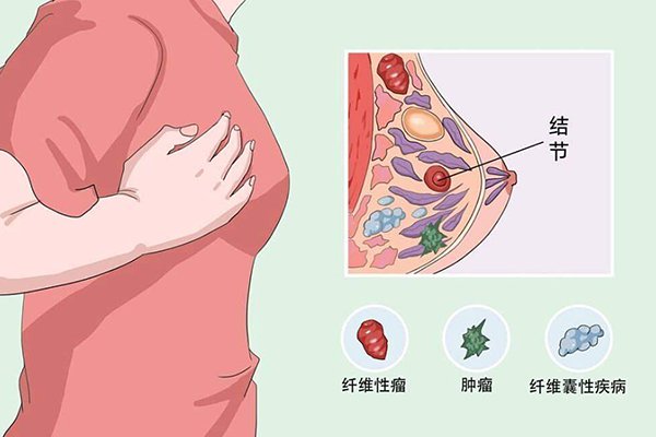 乳腺纖維瘤