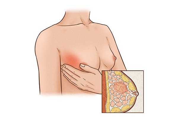 乳腺纖維瘤的預防措施有哪些呢