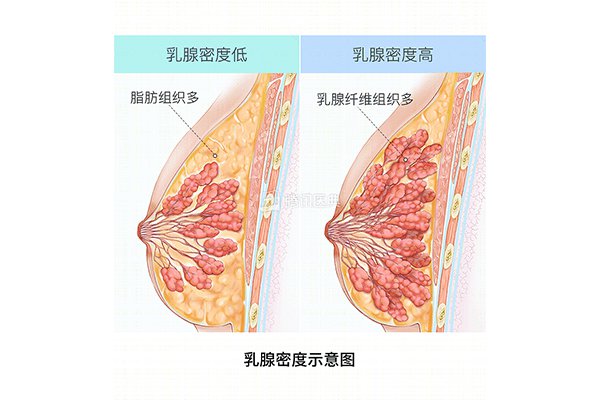 多發性乳腺纖維瘤的癥狀介紹